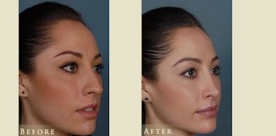 Aesthetic Rhinoplasty Before & After Gallery - Patient 179433 - Image 2
