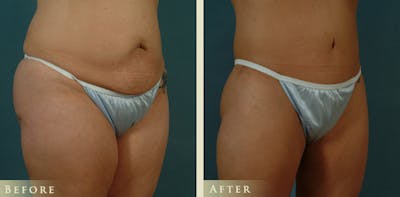 Body Lift Before & After Gallery - Patient 332306 - Image 2