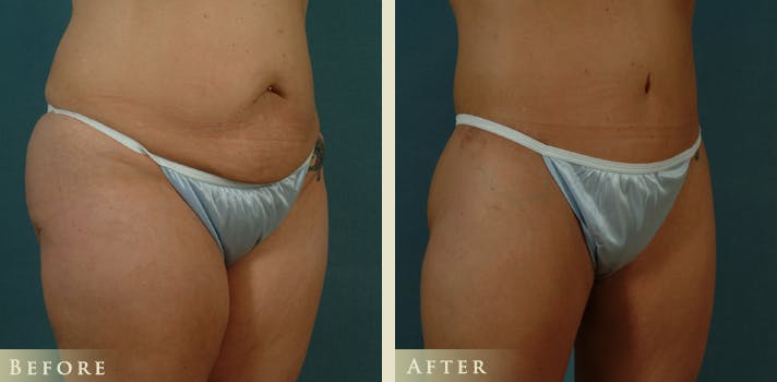Body Lift Before & After Gallery - Patient 332306 - Image 2