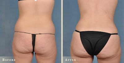 Female Liposuction Before & After Gallery - Patient 322478 - Image 5
