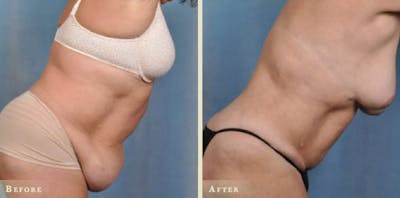Tummy Tuck Before & After Gallery - Patient 306408 - Image 3