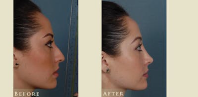 Aesthetic Rhinoplasty Before & After Gallery - Patient 179433 - Image 3