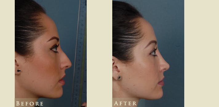Aesthetic Rhinoplasty Before & After Gallery - Patient 179433 - Image 3