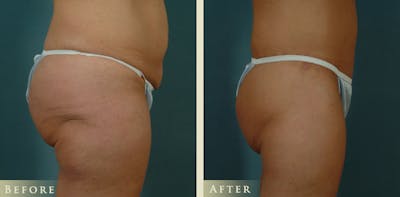 Body Lift Before & After Gallery - Patient 332306 - Image 3