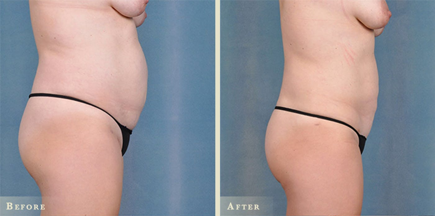 Female Liposuction Before & After Gallery - Patient 377695 - Image 1