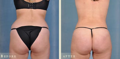 Brazilian Butt Lift Before & After Gallery - Patient 177846 - Image 1