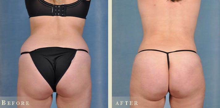 Brazilian Butt Lift Before & After Gallery - Patient 177846 - Image 1