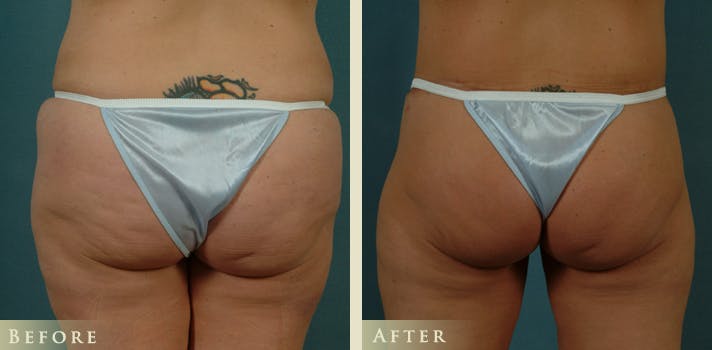Body Lift Before & After Gallery - Patient 332306 - Image 4
