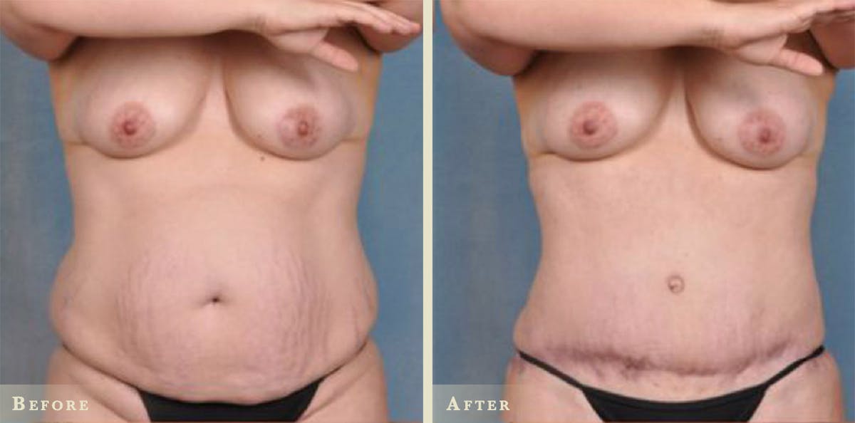 Tummy Tuck Before & After Gallery - Patient 428163 - Image 1