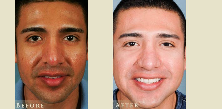 Aesthetic Rhinoplasty Before & After Gallery - Patient 353833 - Image 1