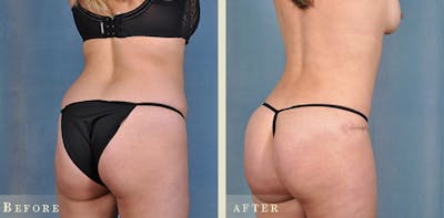 Brazilian Butt Lift Before & After Gallery - Patient 177846 - Image 2