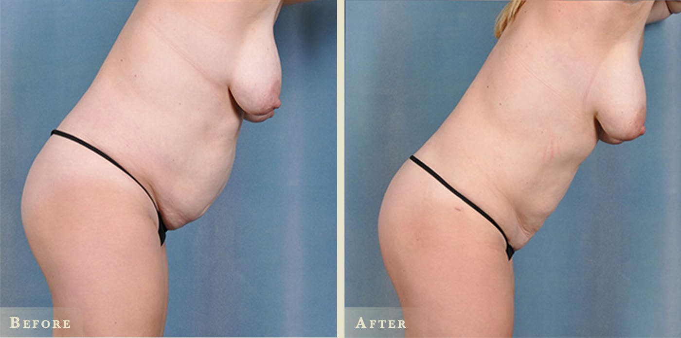 Female Liposuction Before & After Gallery - Patient 377695 - Image 2