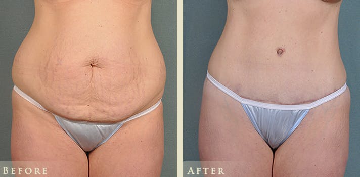 Mommy Makeover Before & After Gallery - Patient 178753 - Image 2