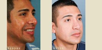Aesthetic Rhinoplasty Before & After Gallery - Patient 353833 - Image 2