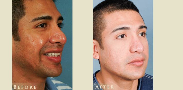 Aesthetic Rhinoplasty Before & After Gallery - Patient 353833 - Image 2