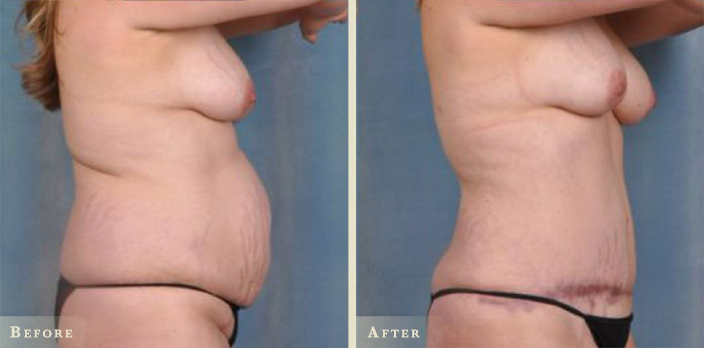 Tummy Tuck Before & After Gallery - Patient 428163 - Image 2