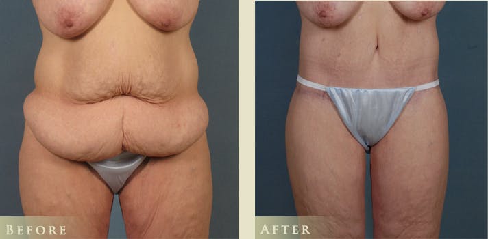 Body Lift Before & After Gallery - Patient 333452 - Image 1