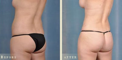 Brazilian Butt Lift Before & After Gallery - Patient 403822 - Image 1