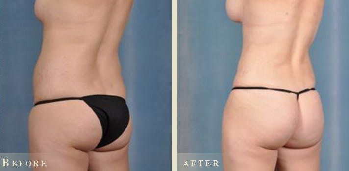 Brazilian Butt Lift Before & After Gallery - Patient 403822 - Image 1