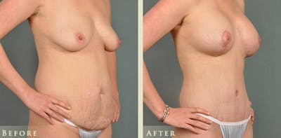 Mommy Makeover Before & After Gallery - Patient 178753 - Image 3