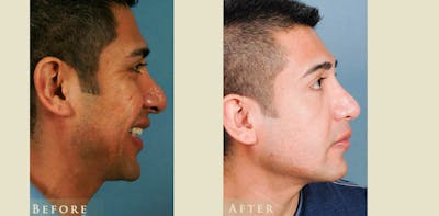 Aesthetic Rhinoplasty Before & After Gallery - Patient 353833 - Image 3