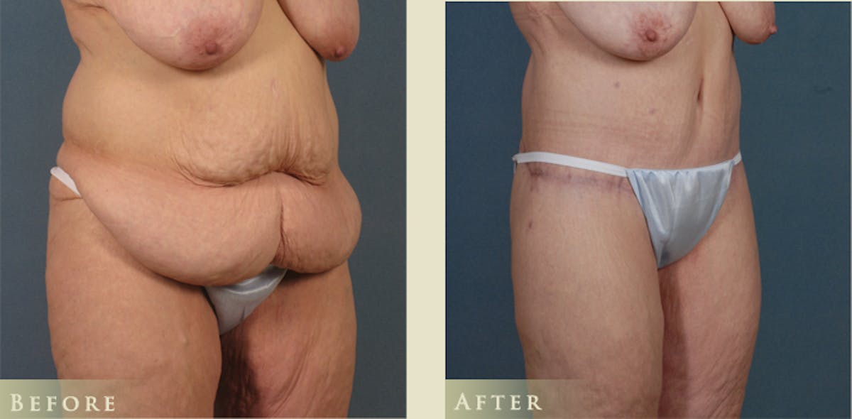 Body Lift Before & After Gallery - Patient 333452 - Image 2