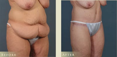Body Lift Before & After Gallery - Patient 333452 - Image 2