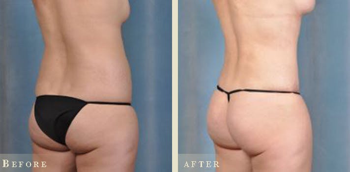 Brazilian Butt Lift Before & After Gallery - Patient 403822 - Image 2