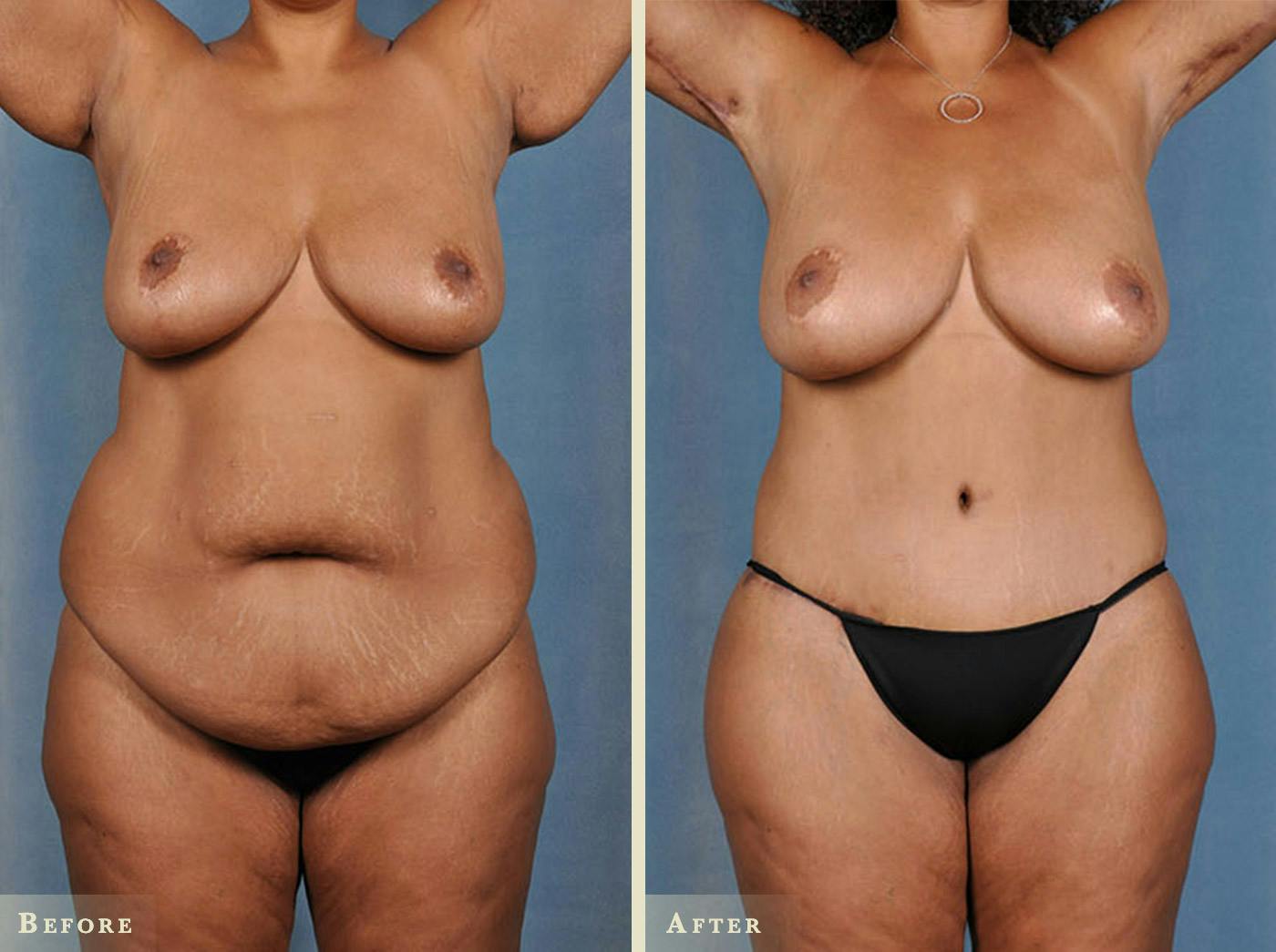 Tummy Tuck Before & After Gallery - Patient 251972 - Image 1