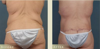 Body Lift Before & After Gallery - Patient 333452 - Image 3