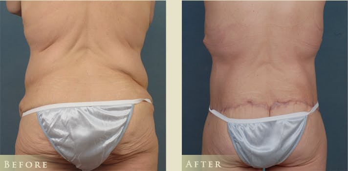 Body Lift Before & After Gallery - Patient 333452 - Image 3