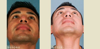 Aesthetic Rhinoplasty Before & After Gallery - Patient 353833 - Image 4