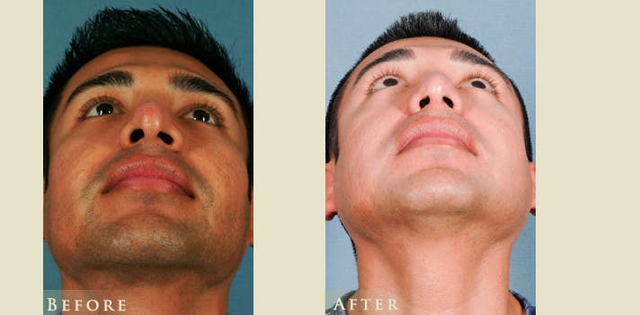Aesthetic Rhinoplasty Before & After Gallery - Patient 353833 - Image 4