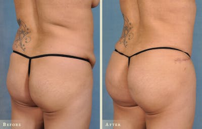 Female Liposuction Before & After Gallery - Patient 250884 - Image 2