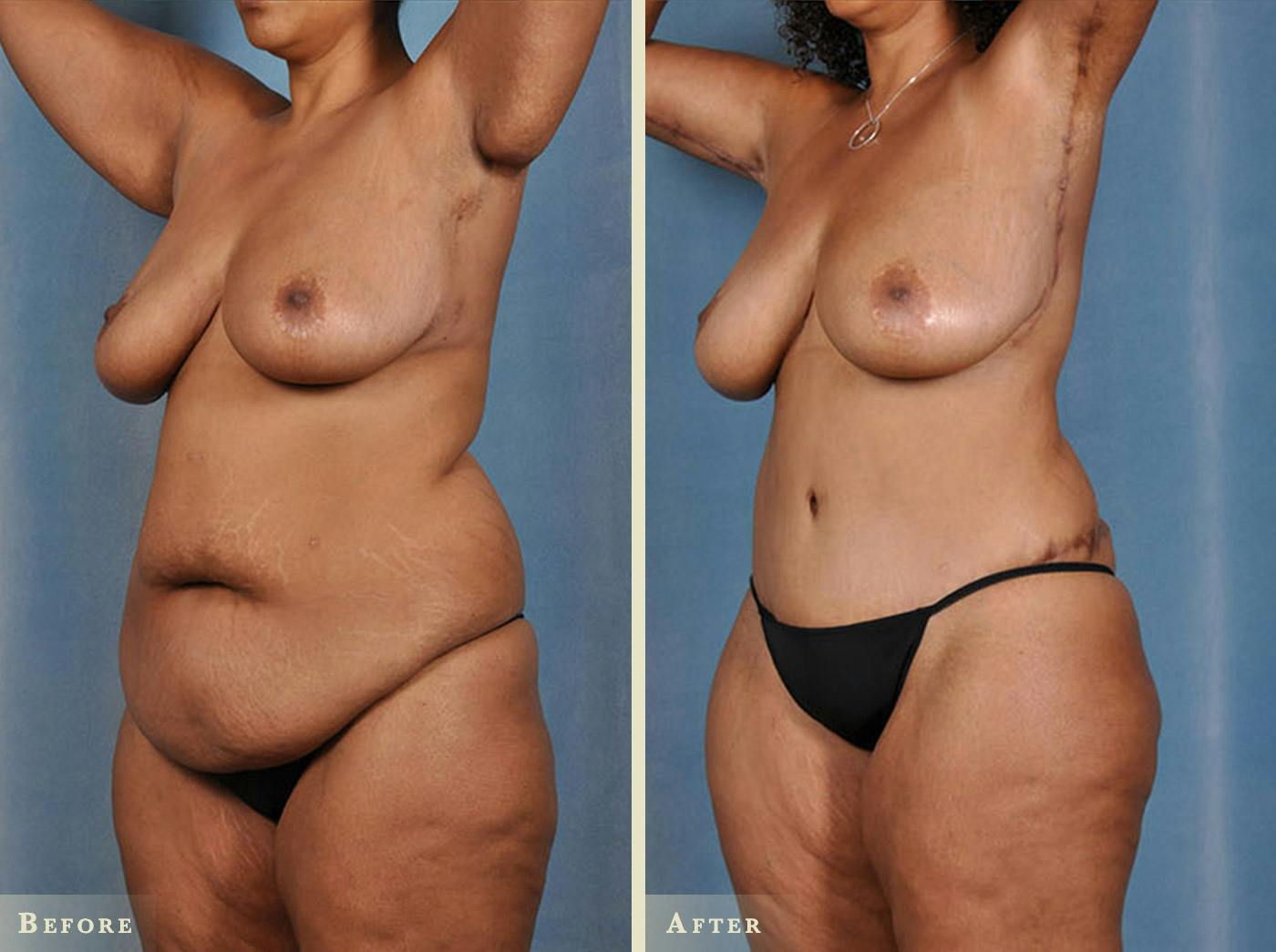 Tummy Tuck Before & After Gallery - Patient 251972 - Image 2