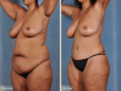 Tummy Tuck Before & After Gallery - Patient 251972 - Image 2