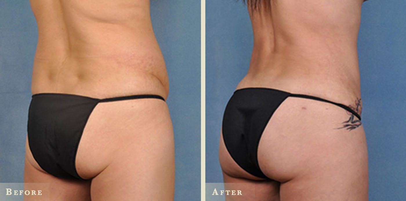 Brazilian Butt Lift Before & After Gallery - Patient 726692 - Image 1