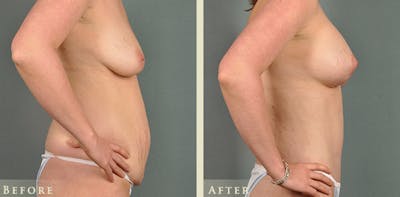 Mommy Makeover Before & After Gallery - Patient 178753 - Image 5