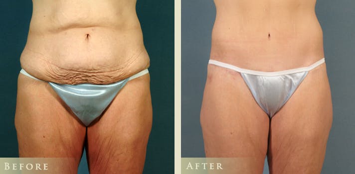 Body Lift Before & After Gallery - Patient 345715 - Image 1