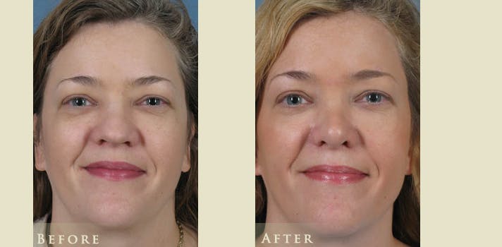 Aesthetic Rhinoplasty Before & After Gallery - Patient 272400 - Image 1