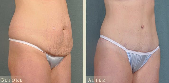 Mommy Makeover Before & After Gallery - Patient 178753 - Image 6