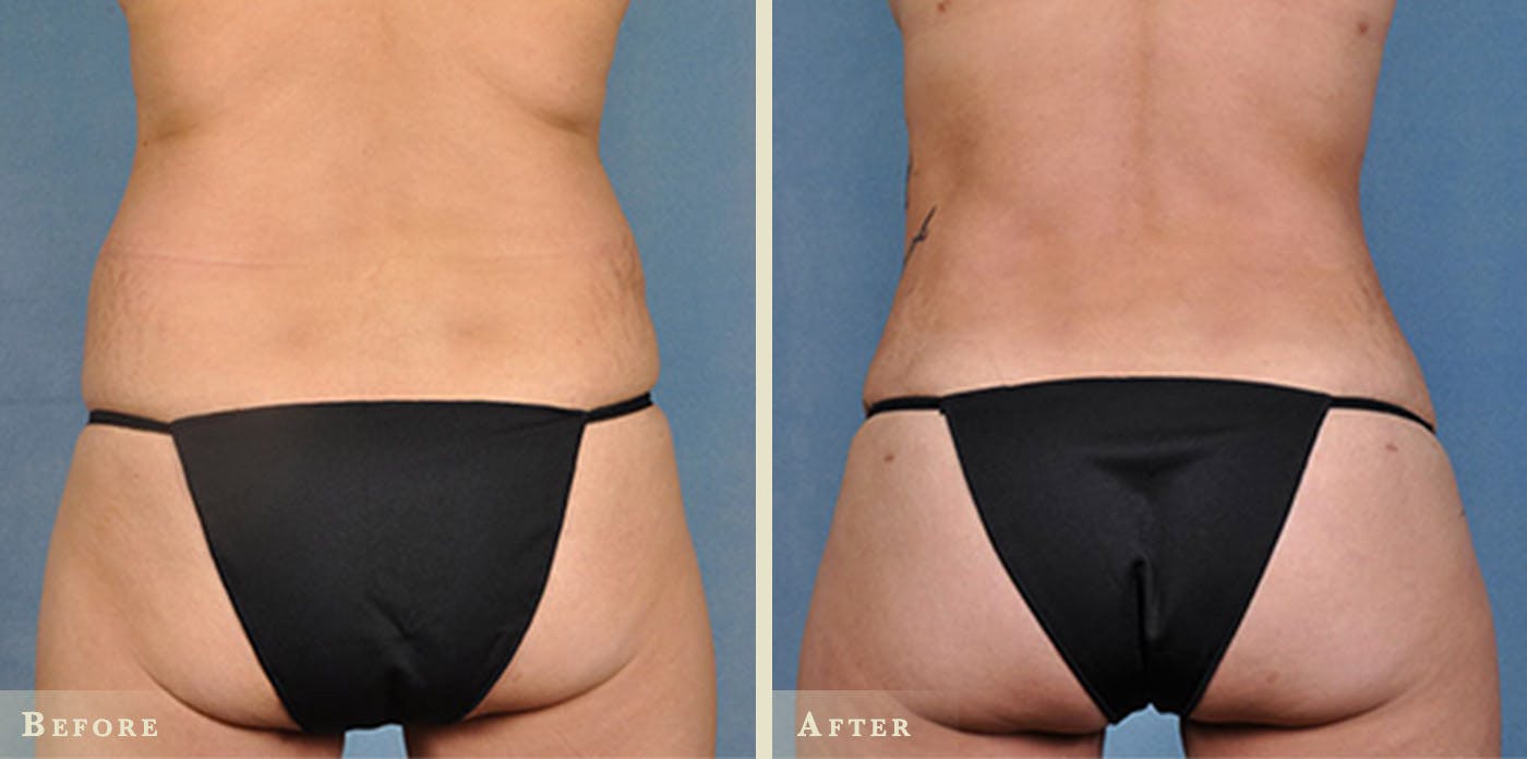 Brazilian Butt Lift Before & After Gallery - Patient 726692 - Image 2