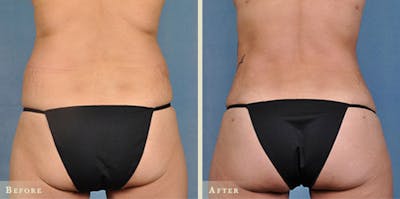 Brazilian Butt Lift Before & After Gallery - Patient 726692 - Image 2