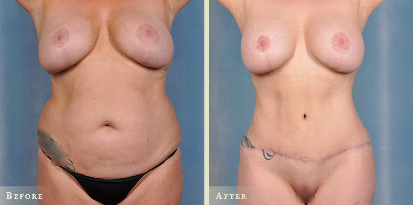 Tummy Tuck Before & After Gallery - Patient 234943 - Image 1