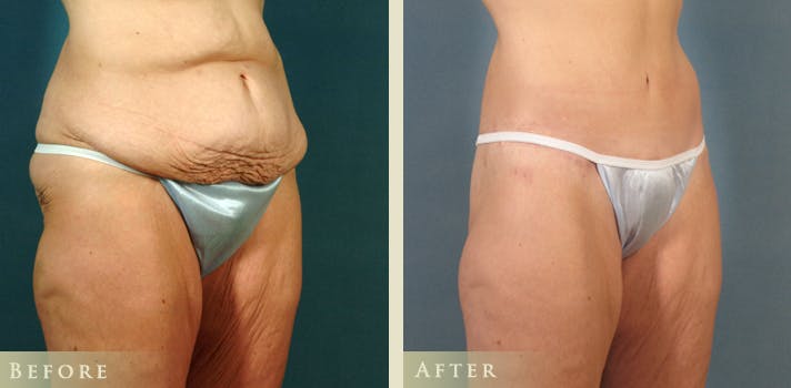 Body Lift Before & After Gallery - Patient 345715 - Image 2