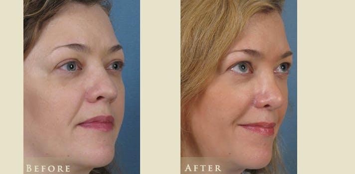 Aesthetic Rhinoplasty Before & After Gallery - Patient 272400 - Image 2