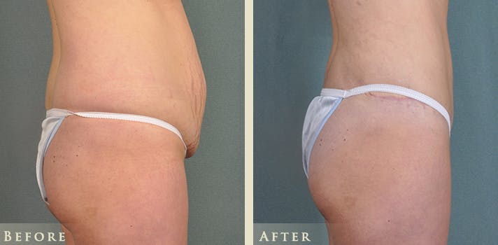 Mommy Makeover Before & After Gallery - Patient 178753 - Image 7