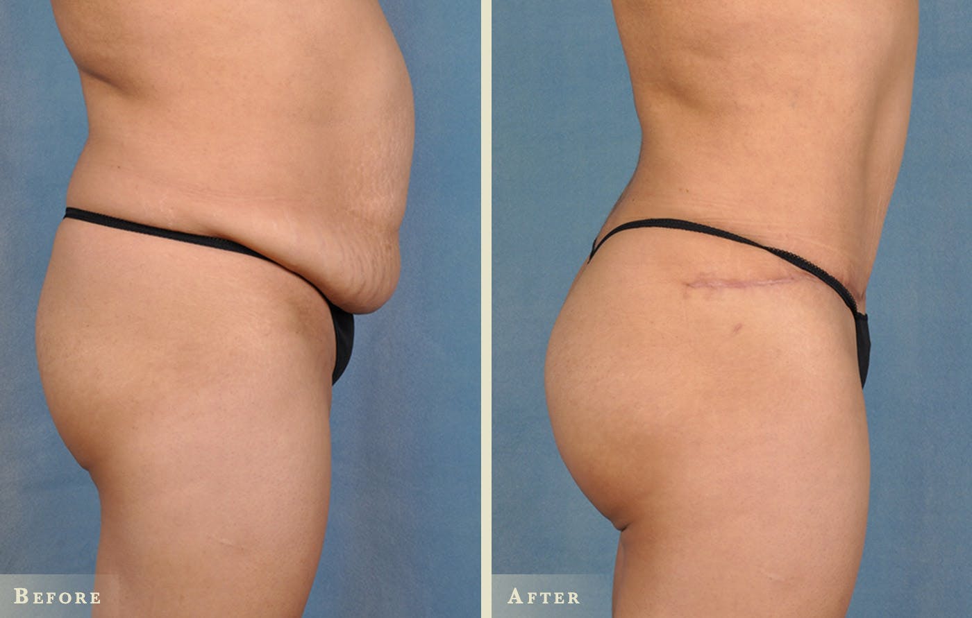 Brazilian Butt Lift Before & After Gallery - Patient 395577 - Image 1