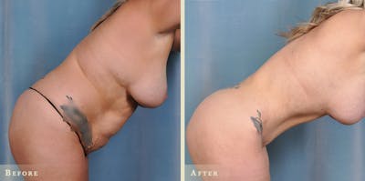 Tummy Tuck Before & After Gallery - Patient 234943 - Image 2