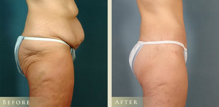 Body Lift Before & After Gallery - Patient 345715 - Image 3